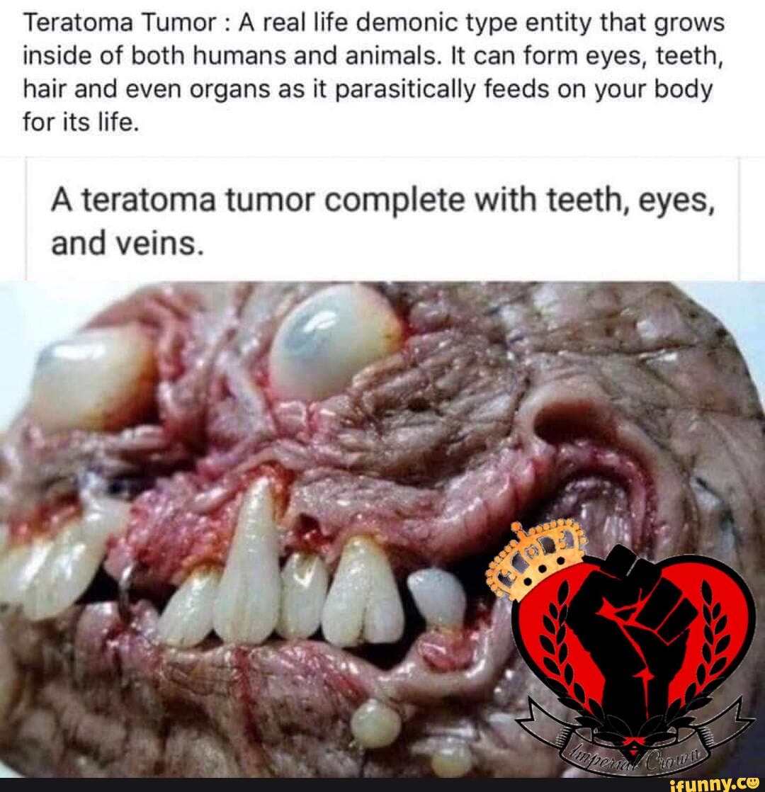 Teratoma Tumor : A real life demonic type entity that grows inside of both  humans and animals.