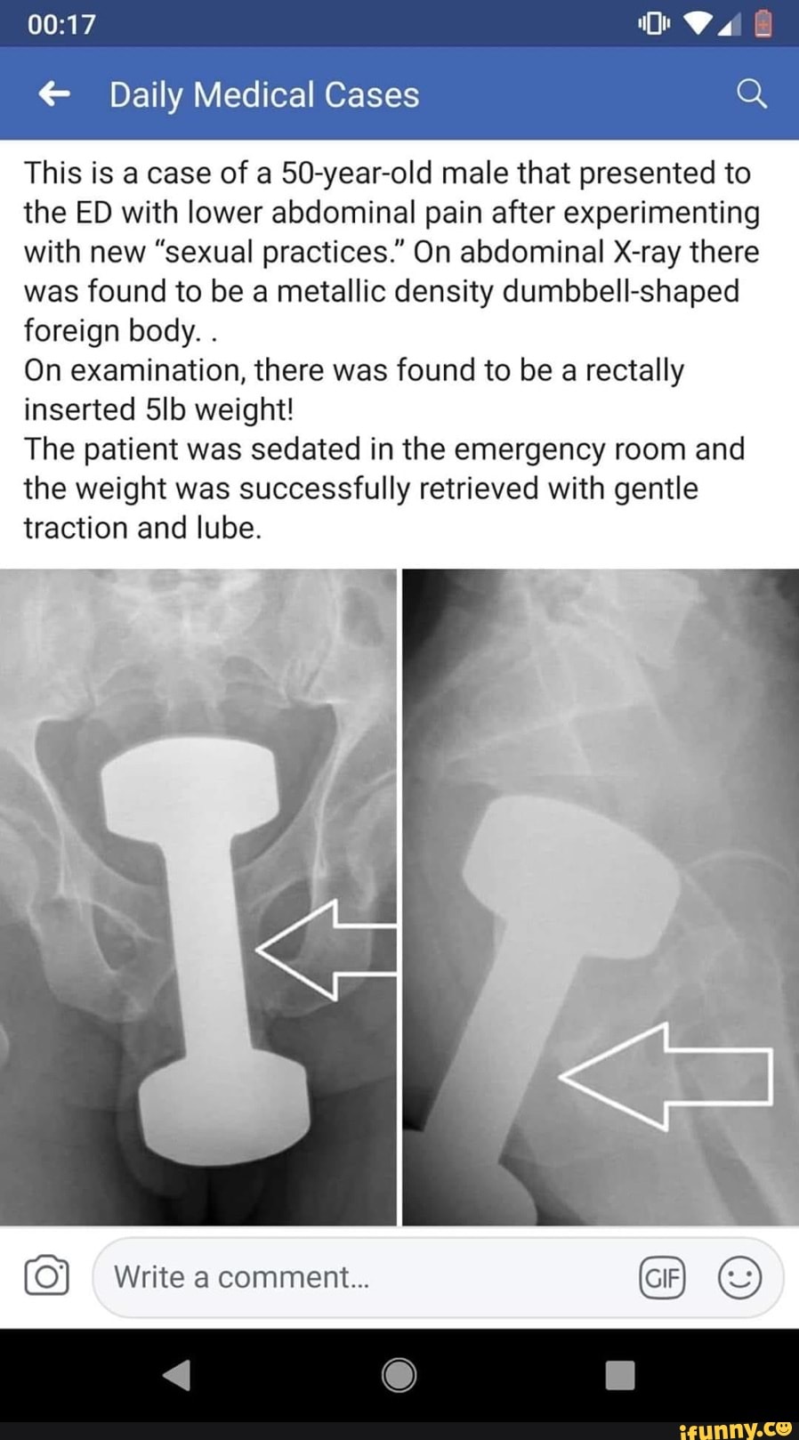 € Daily Medical Cases
This is a case of a 50-year-old male that presented to
the ED with lower abdominal pain after experimenting
with new "sexual practices." On abdominal X-ray there
was found to be a metallic density dumbbell-shaped
foreign body.
On examination, there was found to be a rectally
inserted 5lb weight!
The patient was sedated in the emergency room and
the weight was successfully retrieved with gentle
traction and lube.