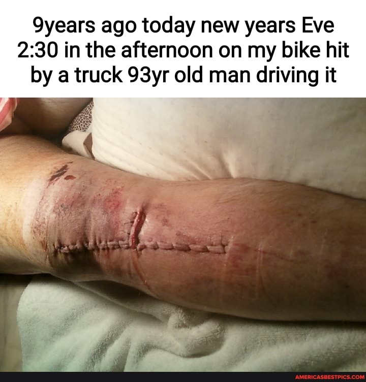Syears ago today new years Eve
in the afternoon on my bike hit by a truck 93yr old man driving it