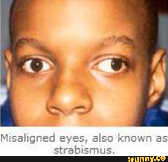 Misaligned eves, also Known as Strabismus. - iFunny