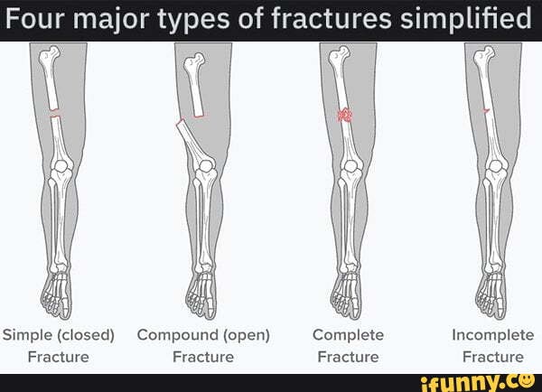 Four major types of fractures simplified Simple (closed) Compound (open ...