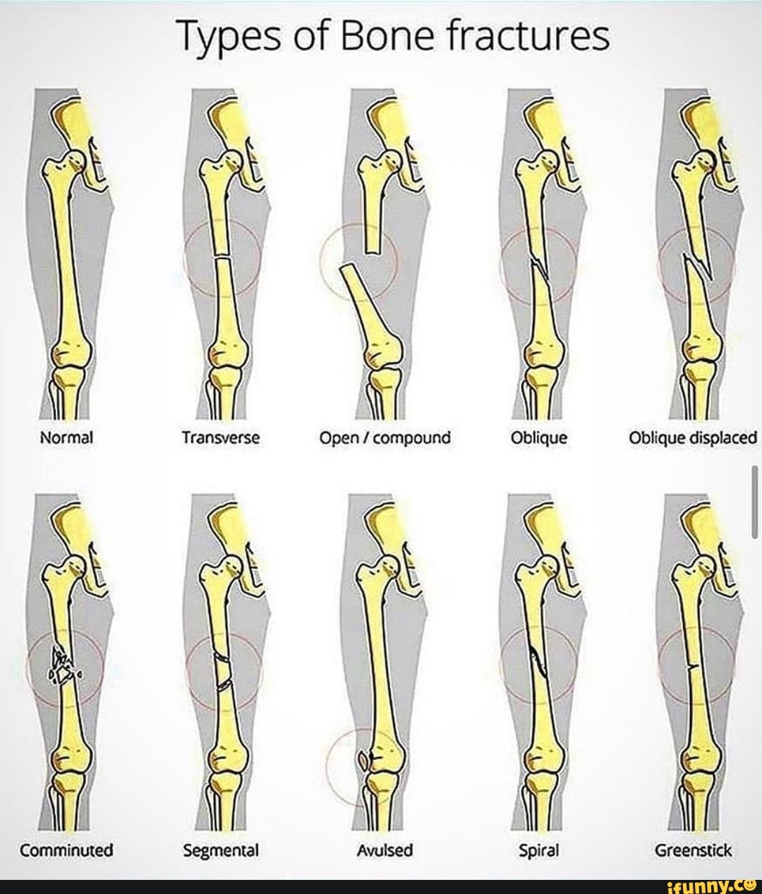 bone fracture vs break