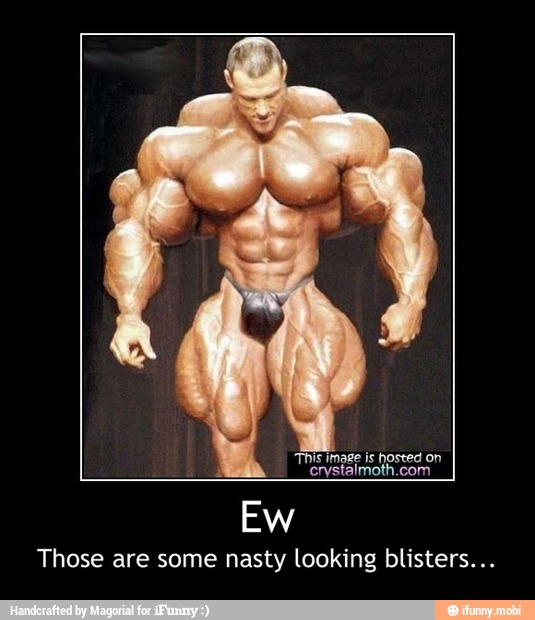 Those are some nasty looking blisters... - Ew
Those are some nasty looking blisters...