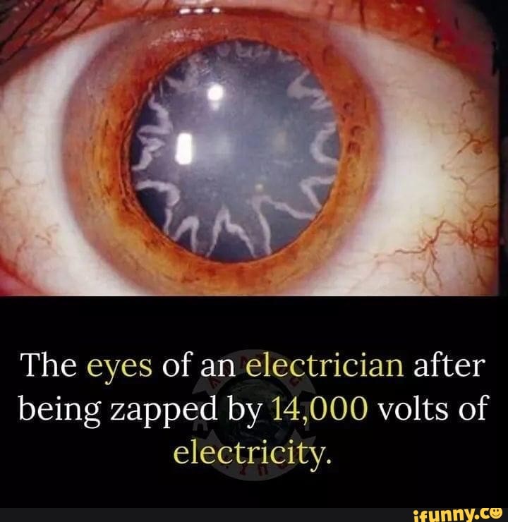 The eyes of an electrician after
being zapped by 14,000 volts of
electricity.