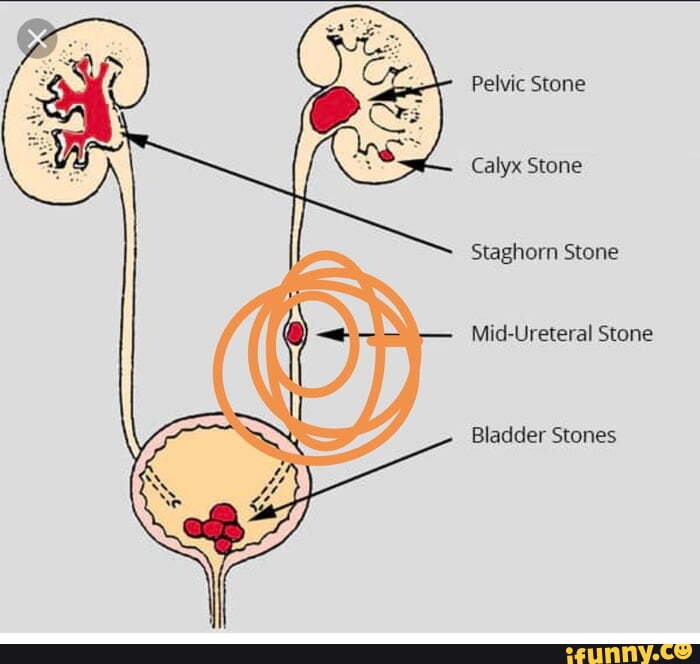 pelvic-stone-calyx-stone-staghorn-stone-mid-ureteral-stone-bladder