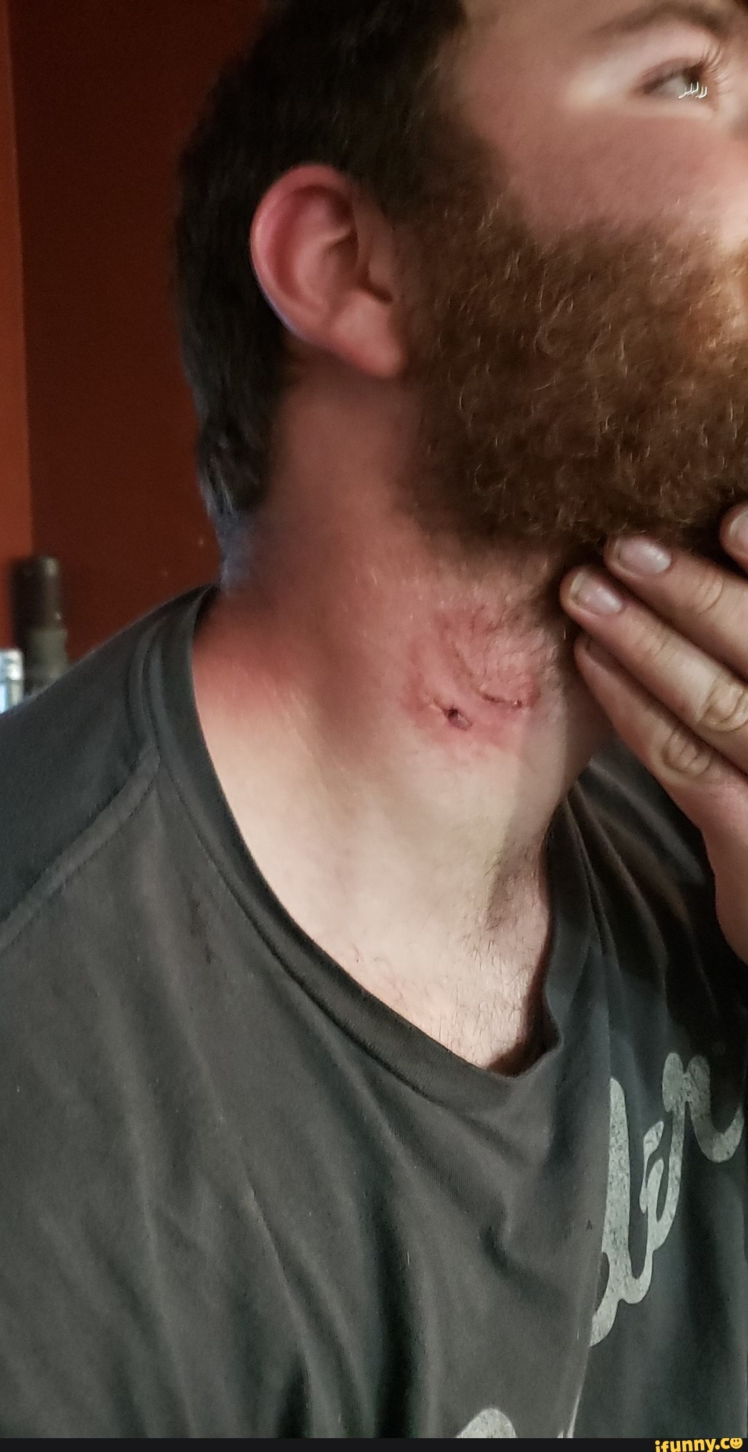 fights, bites