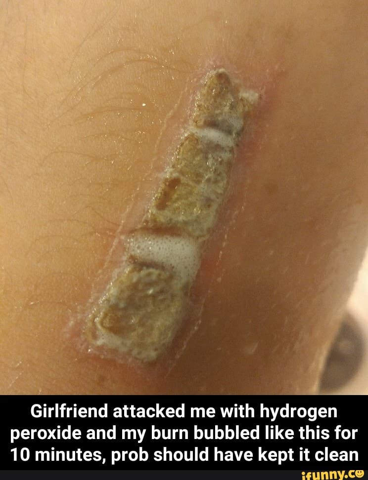 Girlfriend Attacked Me With Hydrogen Peroxide And My Burn Bubbled Like This For 10 Minutes Prob Should Have Kept It Clean Girlfriend Attacked Me With Hydrogen Peroxide And My Burn Bubbled