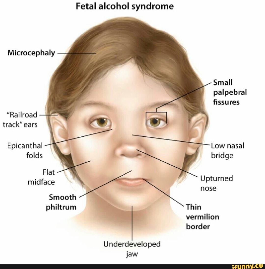 Fetal alcohol syndrome Microcephaly Small palpebral - iFunny