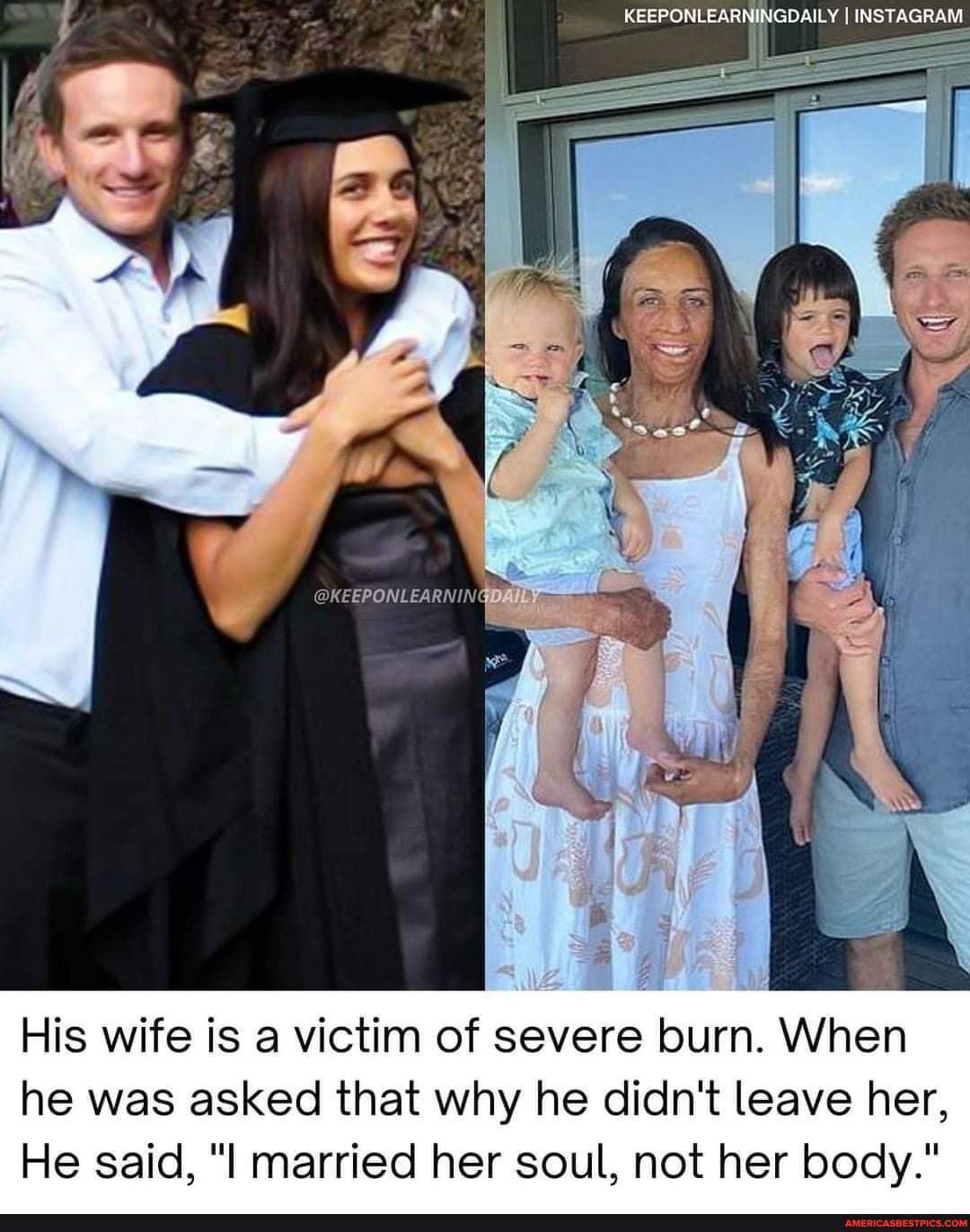 Keeponlearningdaily I Instagram His Wife Is A Victim Of Severe Burn When He Was Asked That Why