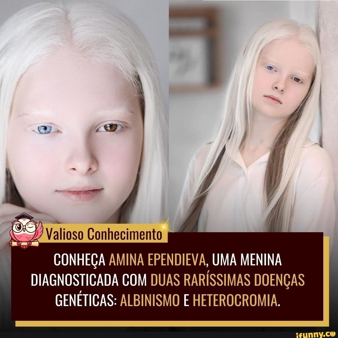 Valioso Conhecimento
CONHEÇA AMINA EPENDIEVA, UMA MENINA DIAGNOSTICADA COM DUAS RARÍSSIMAS DOENÇAS
GENÉTICAS: ALBINISMO E HETEROCROMIA,