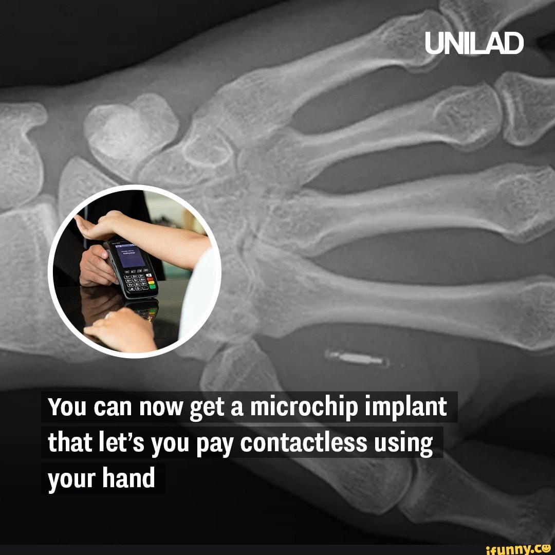 You can now get a microchip implant that let's you pay contactless