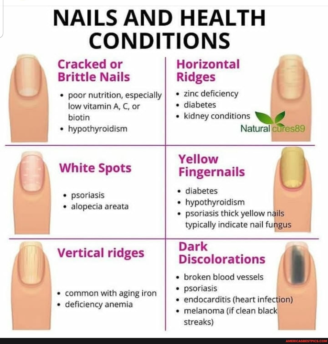 NAILS AND HEALTH CONDITIONS Cracked or Brittle Nails poor nutrition,  especially low vitamin A, C, or