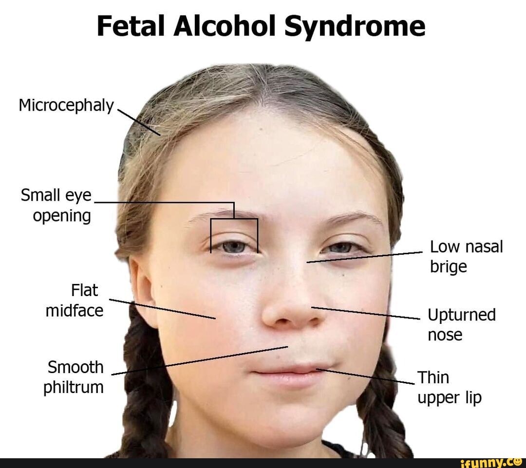 Fetal Alcohol Syndrome Microcephaly Small Eye Opening Low Nasal Brige   Fc2b14b51237e537c8ecb7c339eadd4bd160fcd4155dfa8585c0e2d2024b9662 1 