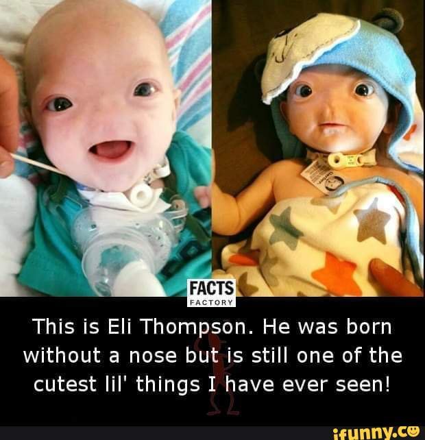 This is Eli Thompson. He was born without a nose but is still one of ...